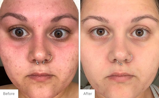 Acne Real Results Image 10